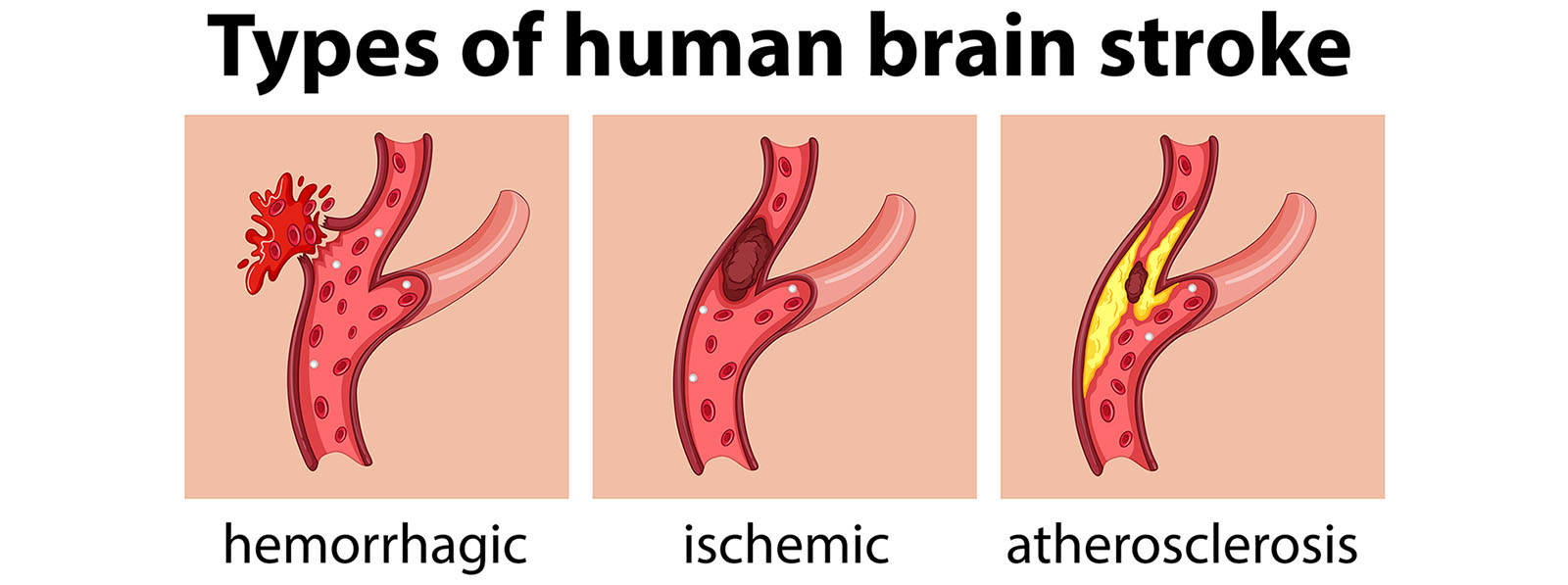 types of stroke